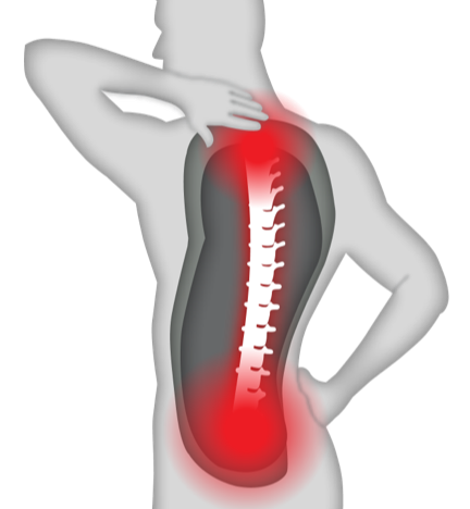 Outline of a human body with pain points on the spine & neck