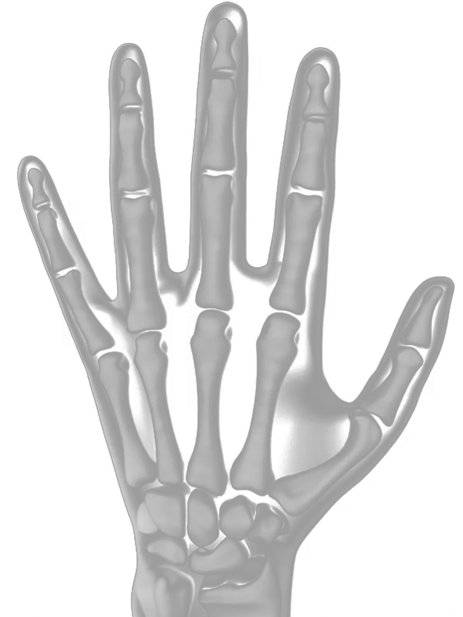 X-ray of a hand showing early RA joint damage
