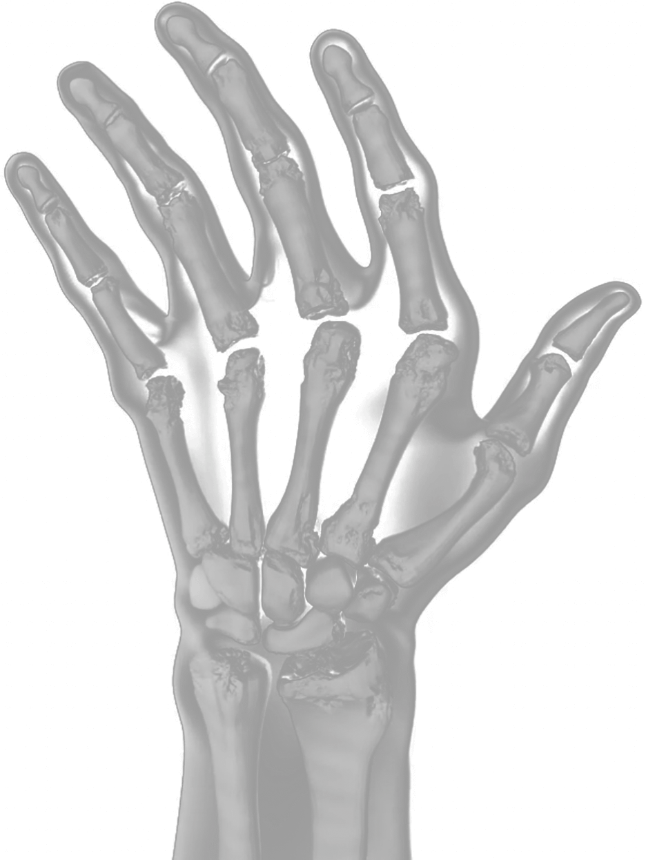 X-ray of a hand showing severe RA joint damage